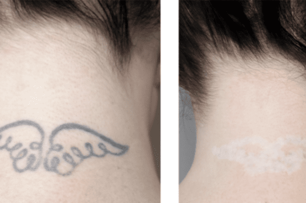 Blush Aesthetics and Beauty Bar | 4 Sessions of Picosecond Laser Tattoo Removal