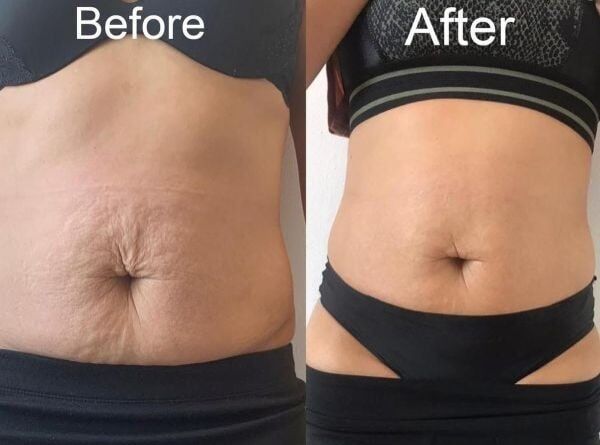 K Beauty Spa | 1 Session of Venus Freeze Abdomen Body Contouring For 1